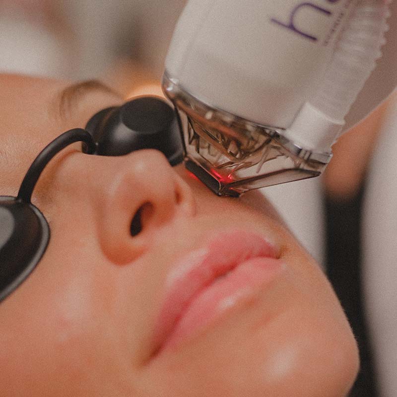 halo laser skin resurfacing at honey skincare studio arlington va