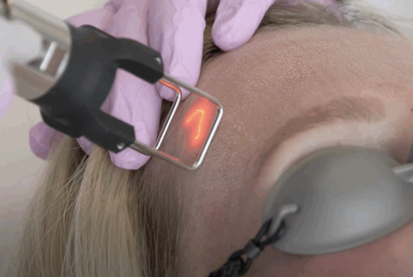 coolpeel co2 laser