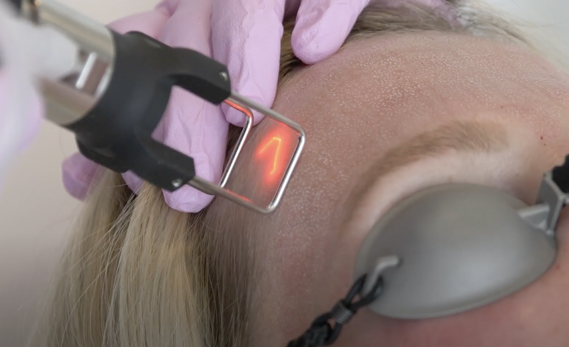 coolpeel co2 laser