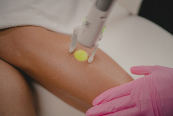 Laser Hair Removal for Men