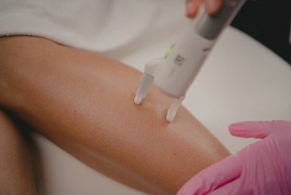 woman going through the varicose vein stages