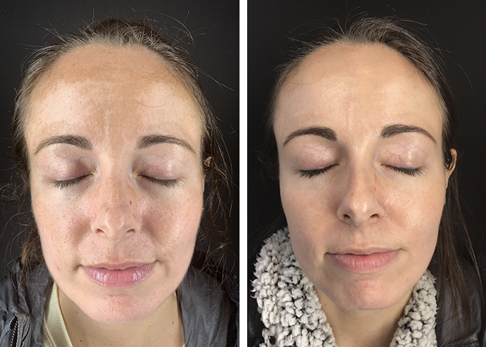 female patient before and after her BBL treatment in Arlington, VA