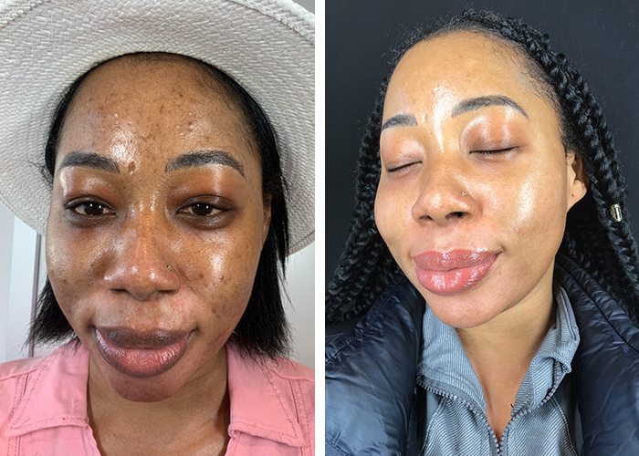 woman before and after her MOXI laser treatment in Arlington, VA