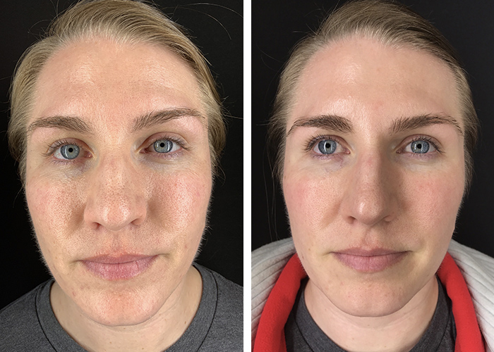 patient before and after her microneedling treatment in Arlington, VA