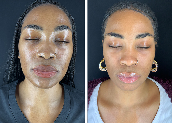 patient before and after her chemical peel in Arlington, VA