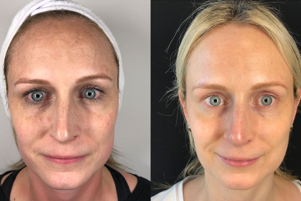 BBL + MOXI combo treatment Arlington VA – Honey Skincare Studio