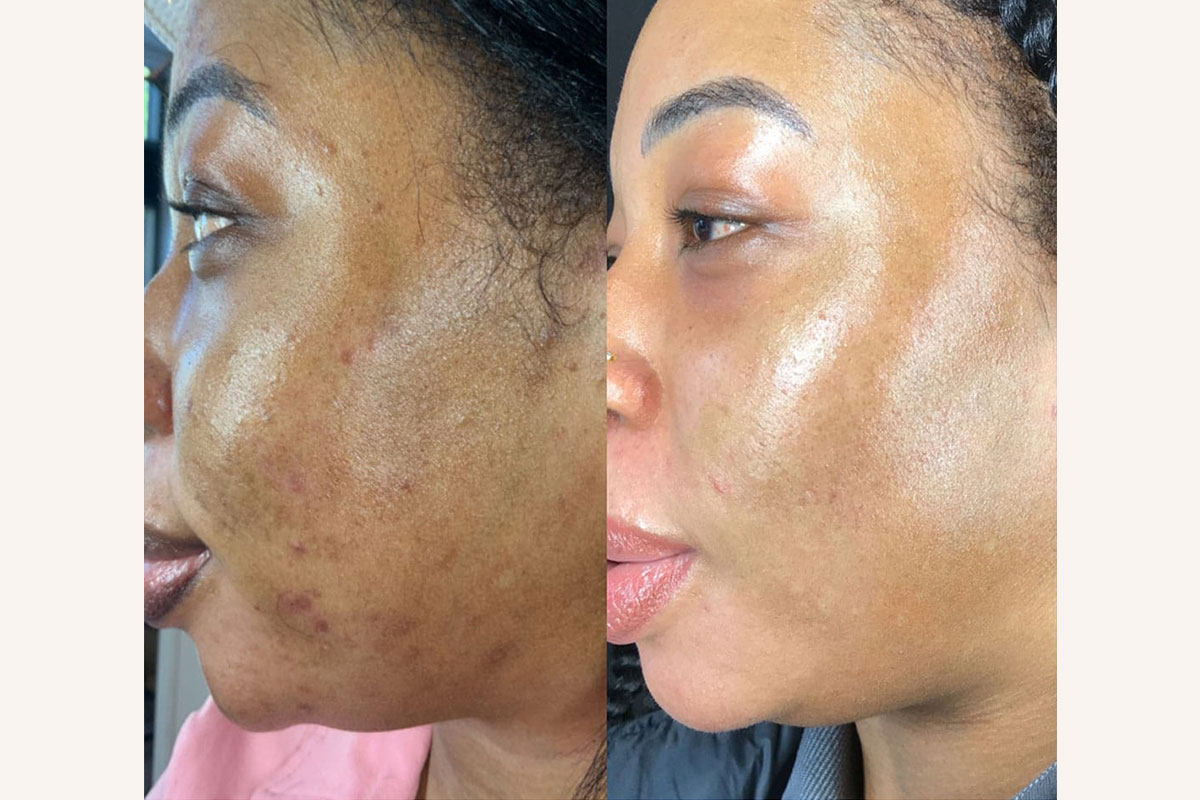 BBL and MOXI before and after photos Arlington VA